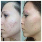 Get-Rid-of-Acne-with-Luminesce